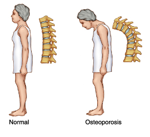 Awas! Osteoporosis Ancam Wanita Muda