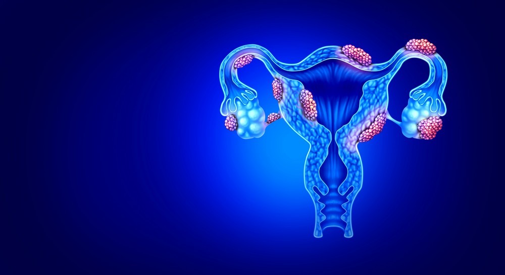 Endometriosis Bayer